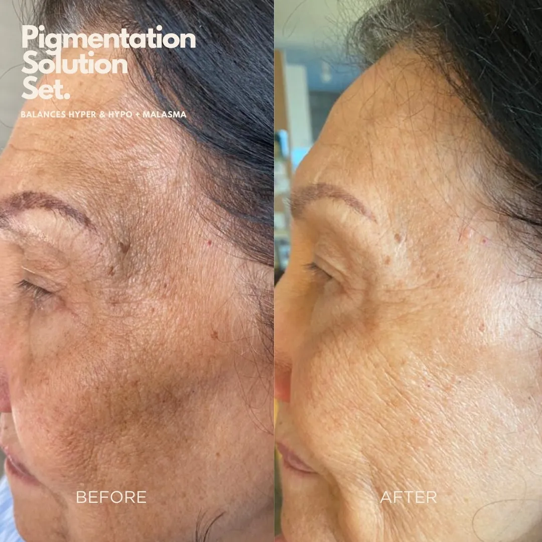 Pigmentation Solution Bundle - Targets Uneven Skin Tone & Dark Marks